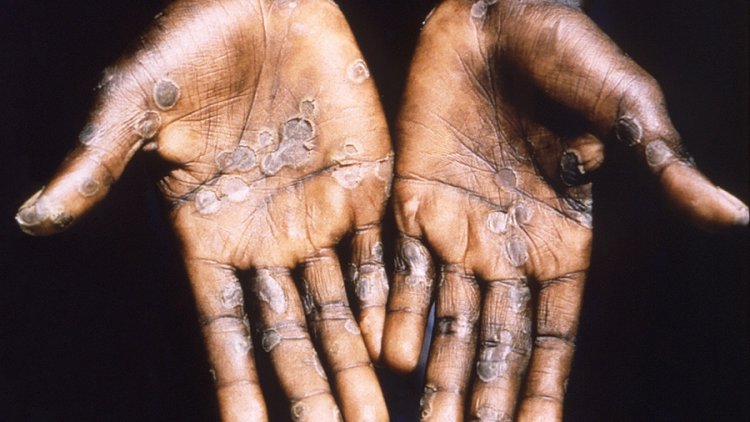 Alerta sanitaria por la viruela del mono