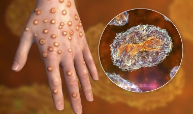 San Juan reporta el primer caso sospechoso de viruela Símica