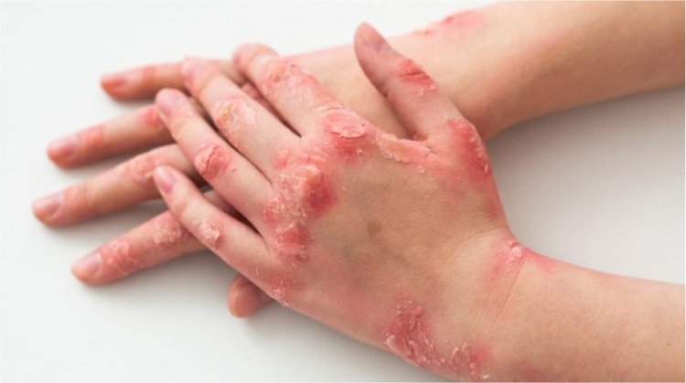 Nuevo consultorio de Psoriasis en el Hospital Rawson