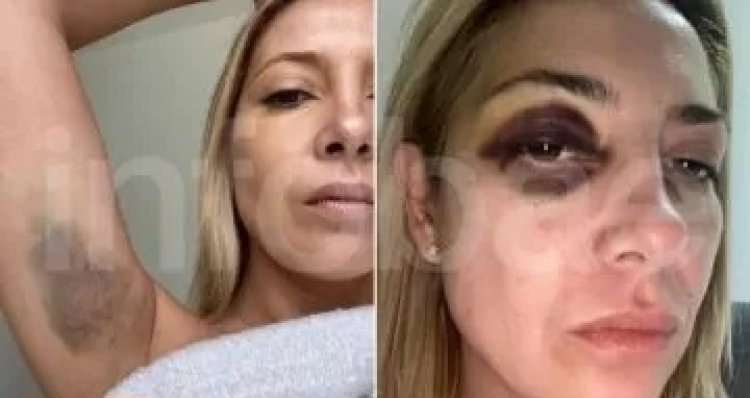 Trascendieron fotos de Fabiola Yañez golpeada tras la denuncia contra Alberto Fernández
