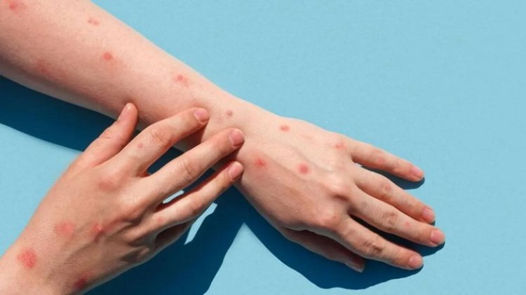 Viruela del mono: cómo se transmite y como prevenir la enfermedad