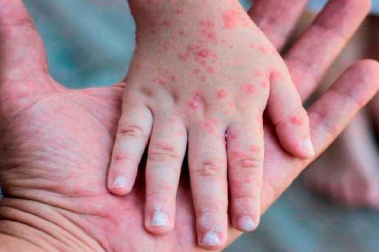 Salud confirmó que dio negativo el caso sospechoso de viruela del mono