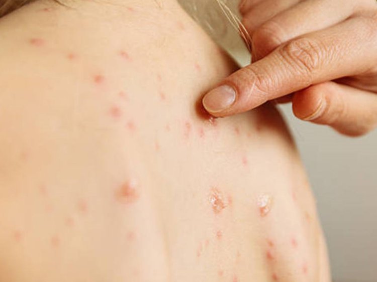 Para la OMS mpox sigue siendo emergencia de salud pública