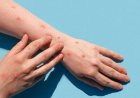 Qué es la mpox y cuáles son las medidas para prevenir la enfermedad