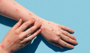 Qué es la mpox y cuáles son las medidas para prevenir la enfermedad