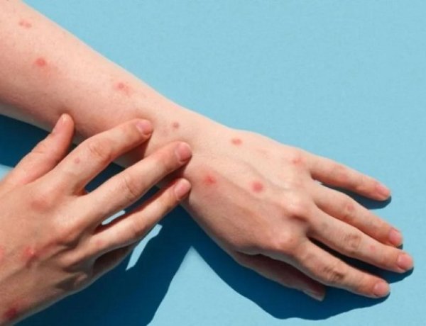 Qué es la mpox y cuáles son las medidas para prevenir la enfermedad